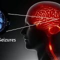 Epilepsy-and-Convulsion Epilepsy-and-Convulsion