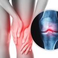 Knee and and X-ray effect with an injured joint Female knee and and X-ray effect with an injured joint
